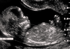 Getting Your First Pregnancy Ultrasound - 18