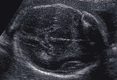 Getting Your First Pregnancy Ultrasound - 87