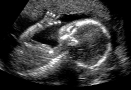 20 weeks ultrasound pictures