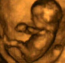 12 week 3d ultrasound