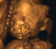 25 weeks fetus ultrasound