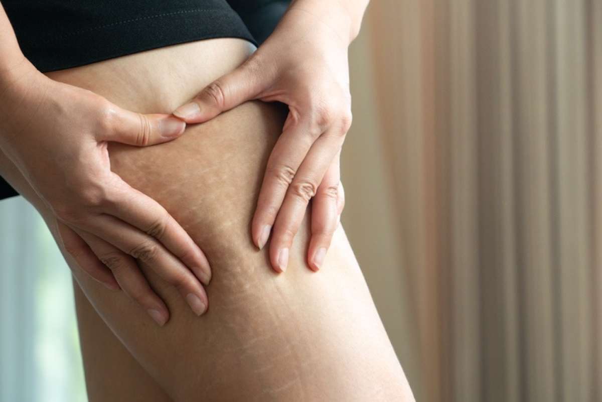 Are Teen Stretch Marks Normal? Causes & Treatments - FamilyEducation