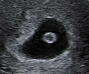 What should you see on a 6 week ultrasound